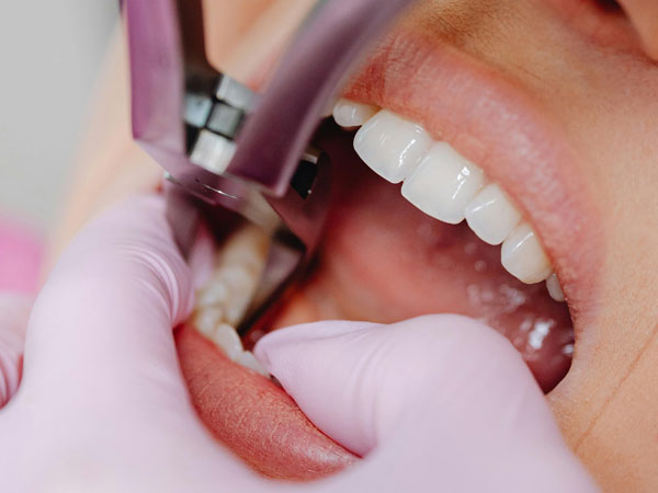 Oral Surgery | Smile Doctors Dental Center