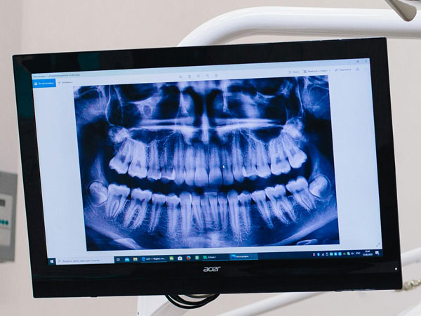 Dental X-ray Services | Smile Doctors DentalCenter